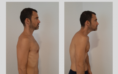 Alteraciones posturales: ¡Cuidado con la chepa!